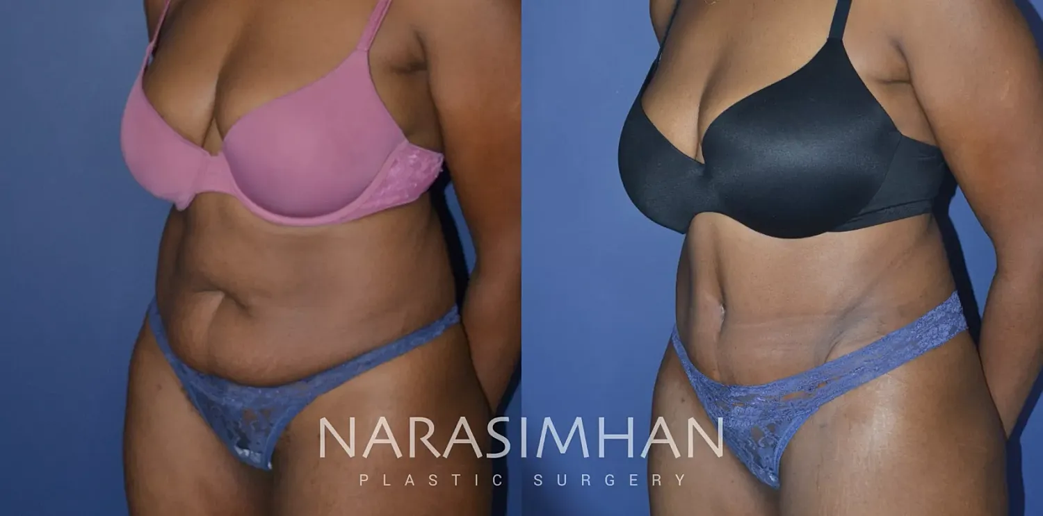 before and after tummy tuck with liposuction patient