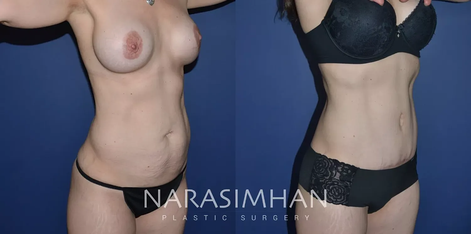 before and after tummy tuck patient