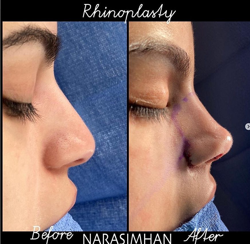 Preservation Rhinoplasty at Narasimhan Plastic Surgery