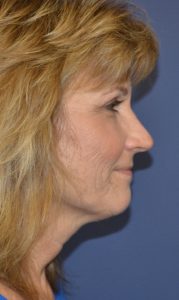 facelift patient before photo profile view