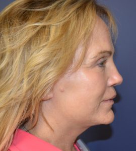 facelift patient after photo profile view