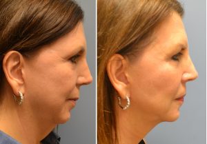 actual neck liposuction patient before and after photos profile view