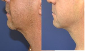 Neck liposuction actual patient before and after photos profile view