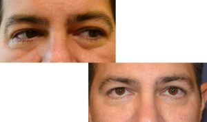 Tear trough fillers before and after photos