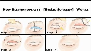 step by step illustration of eyelid surgery procedure