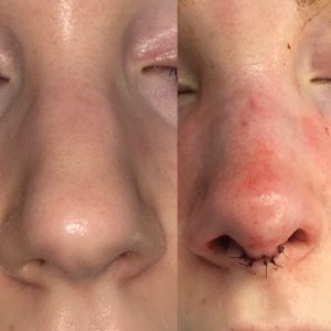 rhinoplasty before and immediately after surgery photos front view