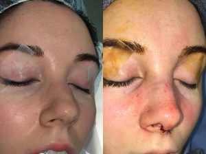 rhinoplasty before and immediately after photos oblique view