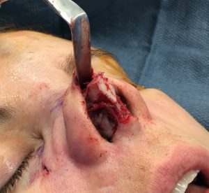 nose during rhinoplasty surgery