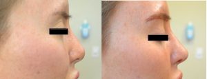 Nonsurgical nose job before and after photos