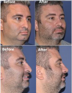 Male rhinoplasty before and after photos oblique and profile views