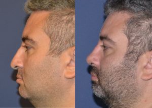 Male rhinoplasty before and after photos profile view
