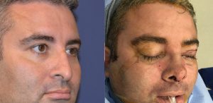 Male rhinoplasty patient before and after photos
