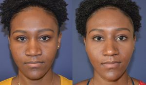Rhinoplasty before and after photos front view
