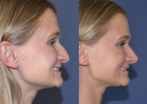 Rhinoplasty before and after photos profile view
