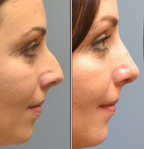 Rhinoplasty before and after photos profile view