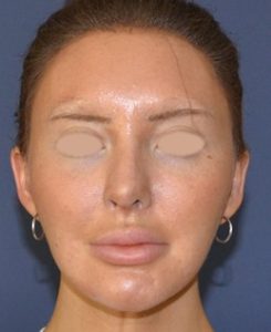 revision rhinoplasty after photo front view