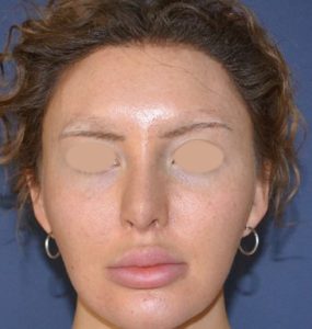 revision rhinoplasty before photo front view