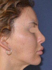 revision rhinoplasty before photo profile view
