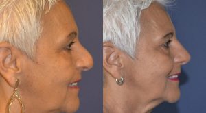 Profile view of woman before and after rhinoplasty.