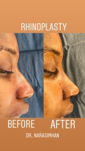 rhinoplasty before and after photos in OR