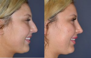 rhinoplasty actual patient before and after photos profile view