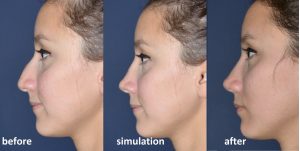 Rhinoplasty before and after photos with simulation profile view