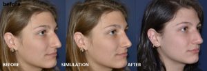 Rhinoplasty before and after photos with simulation in middle