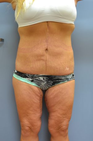 Second actual tummy tuck patient after photo front view
