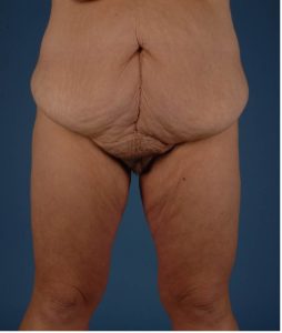 Second actual tummy tuck patient before photo front view