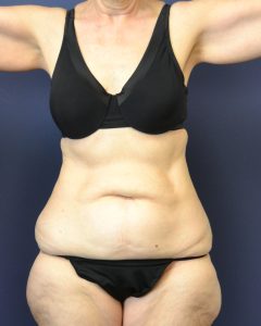Actual tummy tuck patient before photo front view