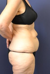 Actual tummy tuck patient before photo side view