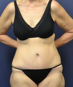 Actual tummy tuck patient after photo front view