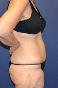 Actual tummy tuck patient after photo side view