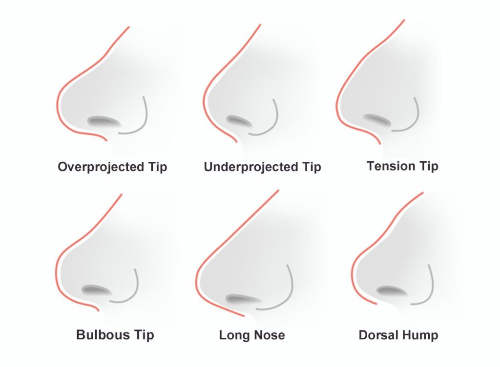 rhinoplasty common characteristics; overprojected tip, unprojected tip, tension tip, bulbous tip, long nose, dorsal hump