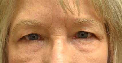 Before photo of patient with sagging upper eyelids