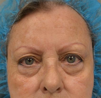 Patient with deep tear trough and puffy eyes from fat content