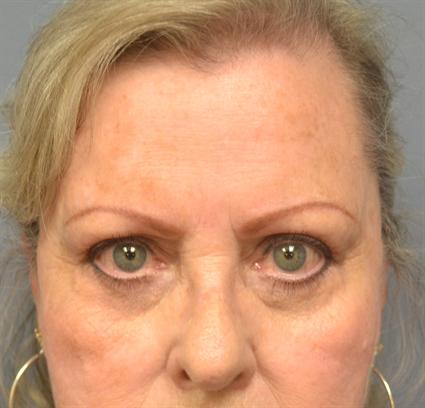 Photo of patient after lower eyelid surgery