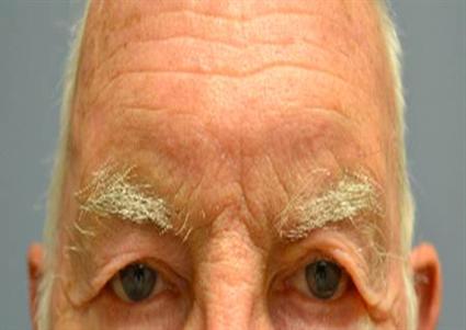 Male patient with severe upper eyelid skin excess