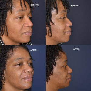 African american woman rhinoplasty before and after photos