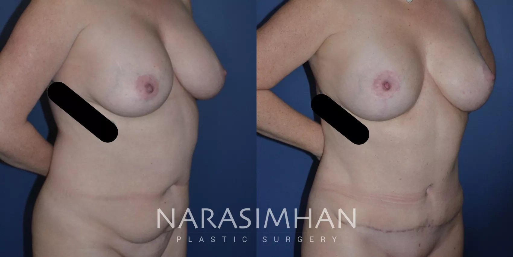 tummy-tuck-abdominoplasty-297-right-oblique-detail